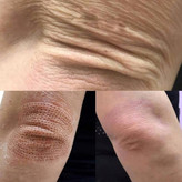 پلاسما پن فیبروبلاست (Plasma Pen Fibroblast)