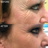 پلاسما پن فیبروبلاست (Plasma Pen Fibroblast)