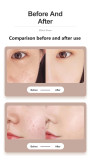 پلاسما پن فیبروبلاست (Plasma Pen Fibroblast)