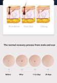 پلاسما پن فیبروبلاست (Plasma Pen Fibroblast)