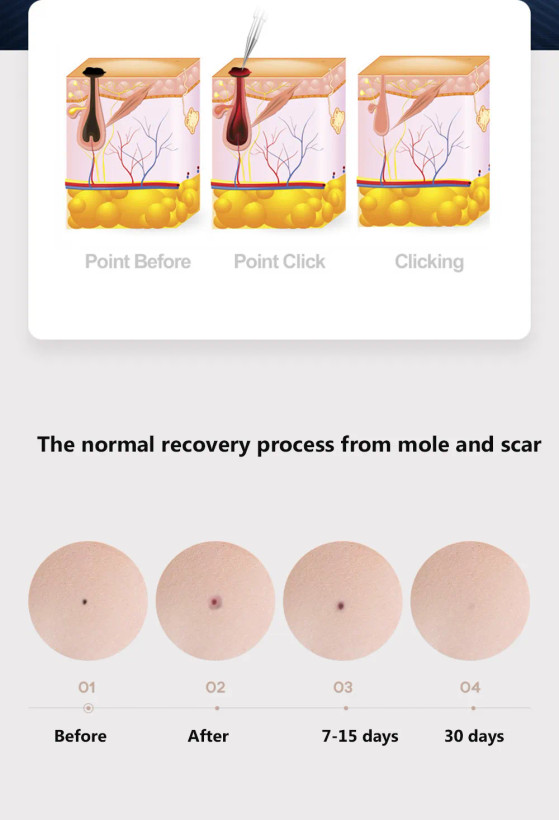پلاسما پن فیبروبلاست (Plasma Pen Fibroblast)